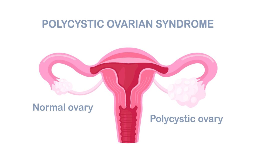 PCOS treatment in Chandigarh